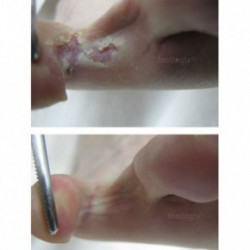 Footlogix Peeling Skin Formula Priešgrybelinė priemonė pėdoms 125ml